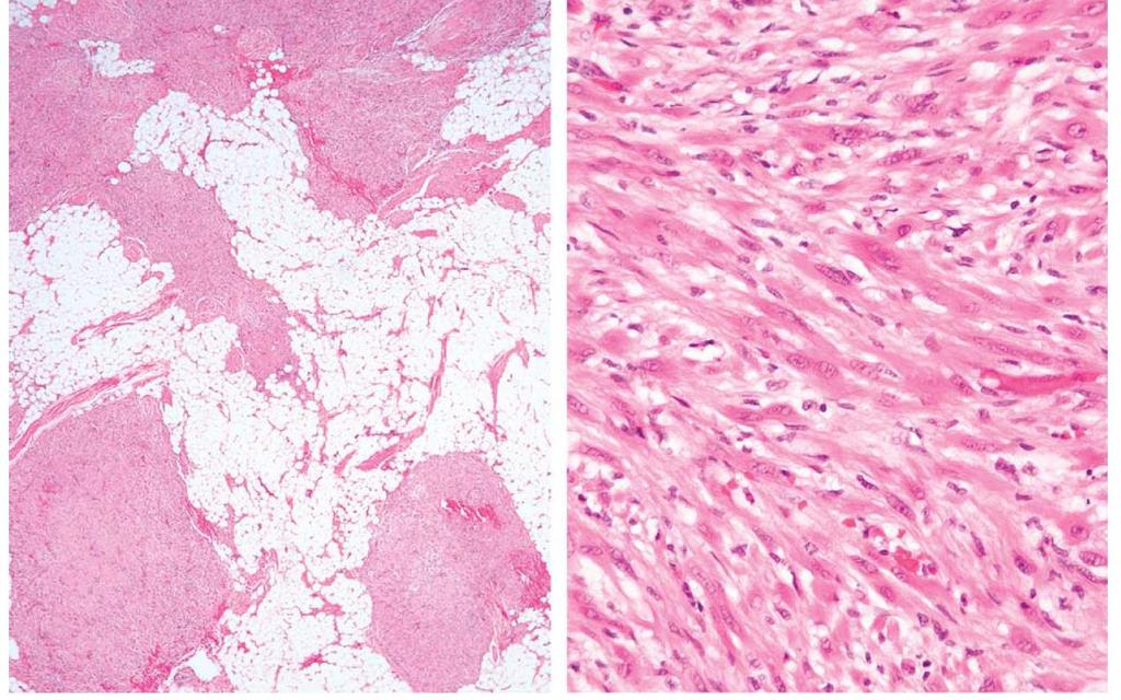 Pseudomyogent hemangioendoteliom Ref.