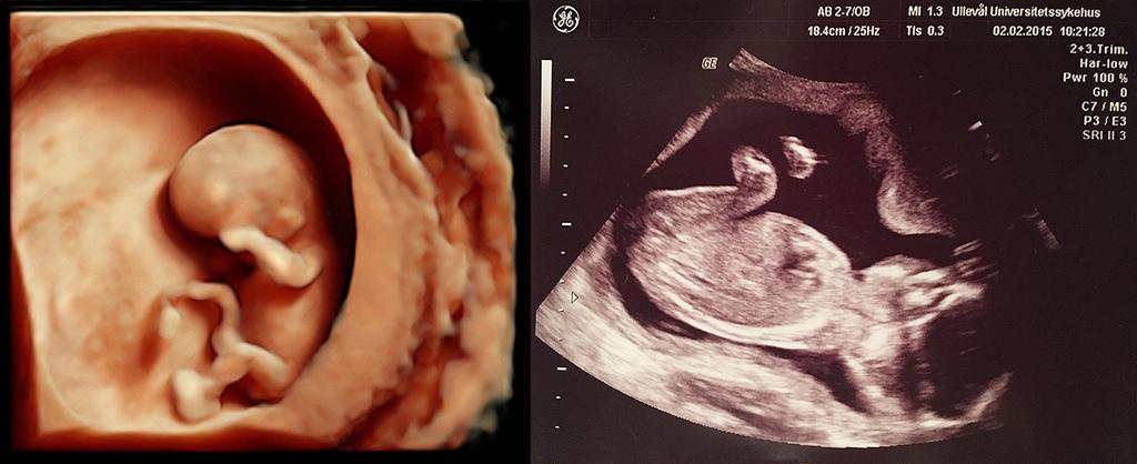 7.2 Stående bølger, musikkinstrumenter, toner 149 Figur 7.3: To ulike ultralydbilder av fostre. Til venstre er et 3D bilde av et foster ca 11 uker gammelt.