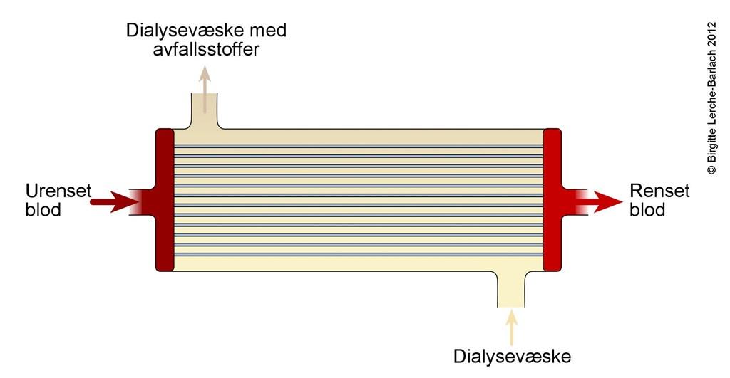 Hemodialyse Ved hemodialyse ledes blod fra pasienten i en krets gjennom den kunstige nyrens kapillærer, hvor dialysevæske strømmer motstrøms mot blodet.