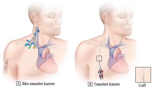 Ikke-tunnelert kateter Disse katetrene skal helst unngås, og er ment for korttidsbruk og skal sikre umiddelbar vaskulær tilgang.