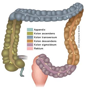 Tykktarm/endetarmskreft (colorectal cancer, CRC) Mange rammes 3500 nye tilfeller pr år 70