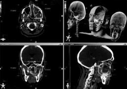 CT + PET CT-undersøkelse i behandlingsposisjon Evt.