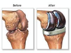 Kneprotese Totalprotese (helprotese) Ved stor skade av brusken i kneleddet velges en totalprotese.