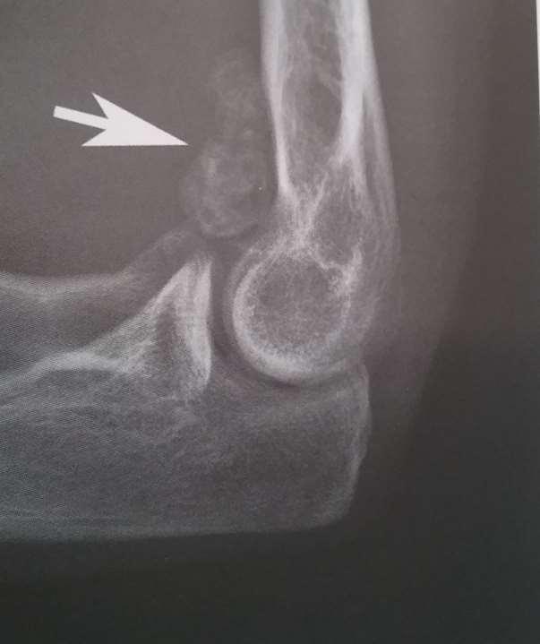 Synnovial chondromatose