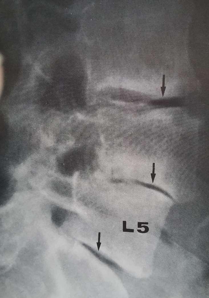 I TH / L-columna gir RA subakutte spondylodiskitter.