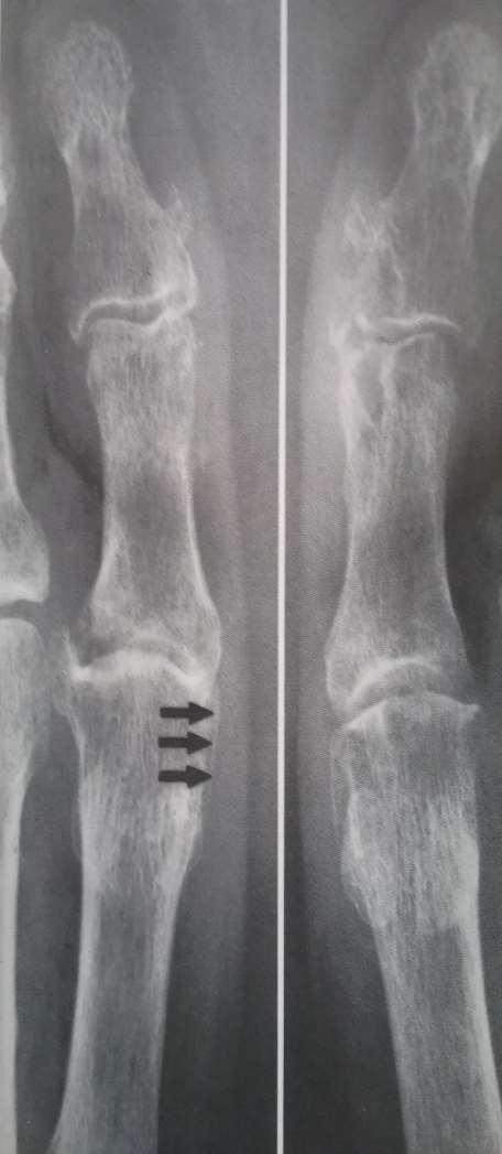 Skarpt avgrenset osteolyse.