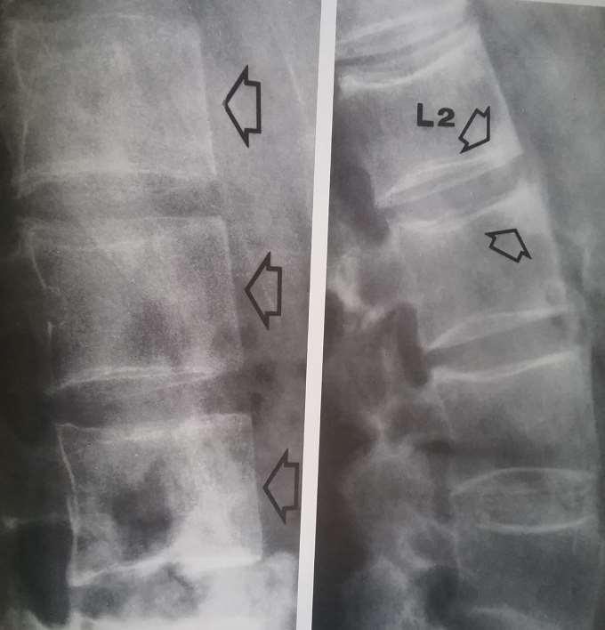 Økende sklerose. Så kommer forbening i fremre lengdebånd. Såkalt spondylitis anterior.