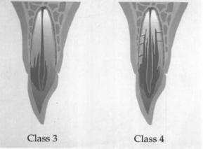 Klasse 1: en invasiv lesjon i cervikalområdet med kun liten utbredelse inn i dentin.