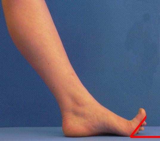 Test av dorsalfleksjon av stortåa (Metatarsophalangialleddet) Dorsalfleksjon av stortåa er viktig for flere sentrale funksjoner i foten, slik som: Windlassfunksjonen (meny 5.