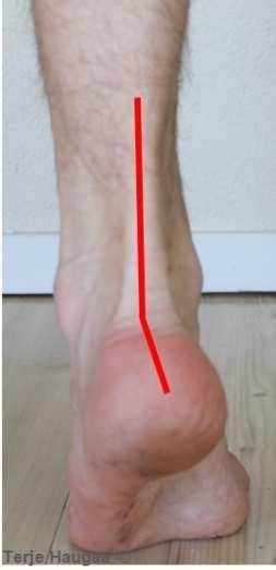 Ved nedsatt bevegelse i dette leddet påvirkes støtdempingen. Test av subtalarleddet venstre fot Terje Haugaa Fig 5. Normal valgus stående er 5. Det er anatomisk betinget. Fig 6.
