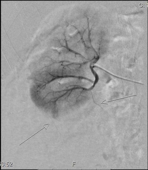 Angiografi Gjøres både fra nyrearterien proximalt og selektivt fra de forskjellige grener.