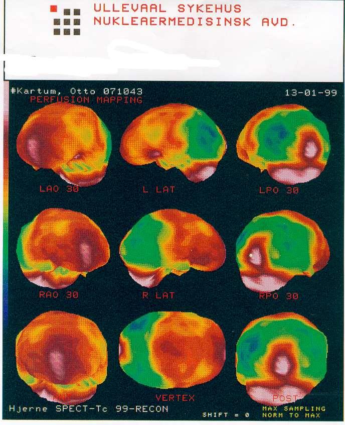 Alzheimer Sykdom Lite gjennomstrømning i begge