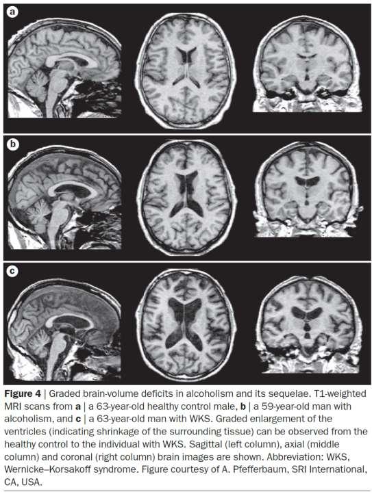 MRI a) Kontroll b) Alkoholisme c) Wernicke-