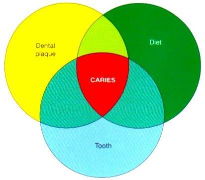 Den mest kjente fremstillingen av karies er fra 1960 der Keyes betegnet karies som et samspill av mange faktorer (53) for å få karies i en tann måtte det være en mikroflora tilstede (i plakket) som