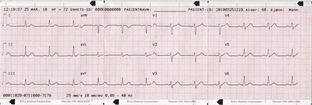 E Series 12-avlednings EKG-overvåkning Tilleggsvedlegg 12-avlednings EKG-kurver FORSIKTIG 12SL-analyseresultatene kan påvirkes av dårlig kvalitet på EKG-dataene.