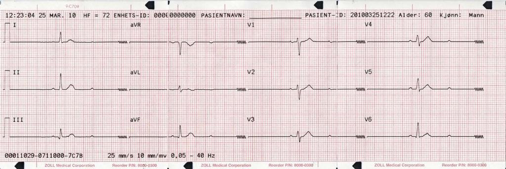 12-avledningsrapporter Formatet 2x6 (kun rapport via Direkte FAX) Formatet 2x6 skriver ut alle 12-avlednings EKG-data som er registrert i det første intervallet på 5 sekunder.
