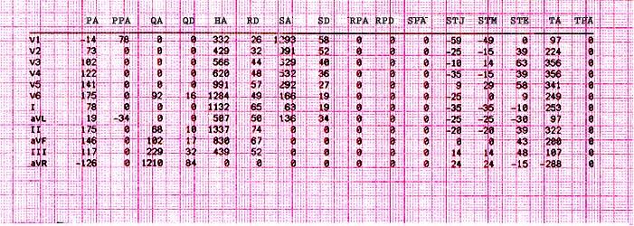 E Series 12-avlednings EKG-overvåkning Tilleggsvedlegg Pasientinformasjon Målingsmatrise Enheten kan konfigureres til å skrive ut en målingsmatrise som består av målinger for hvert segment i hver