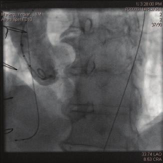59 Figur 5. Aortografi ved start av prosedyre med pig-tail-kateter i aortaroten. Pacemaker til høyre ventrikkel. Figur 6. Fullt ekspandert valvuloplastikkballong i aortaostiet. Figur 7.