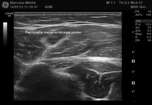 Supraspinatus, primær og sekundærtegn på ruptur / partiell ruptur Dorsale labrum, Hill Sachs skader,