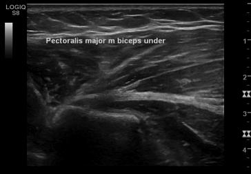 Klinisk bicepsvurdering: Pectoralis major frisk: Standard isometrisk test- forkast? Test liggende.