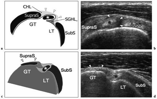 Subscapularis testing: Test isometri i medialrotert utgangsstilling (mage- rygg)