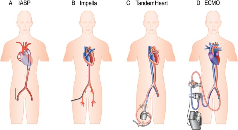 Mekanisk sirkulasjonsstø8e From: Mechanical circulatory support in cardiogenic shock Eur Heart J. 2013;35(3):156-167. doi:10.