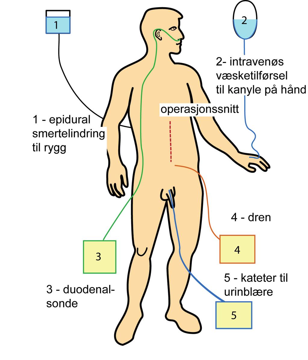 Utstyr som ofte brukes ved en større operasjon Illustrasjon av utstyr 1. Epiduralkateter legges inn før operasjonen av anestesilegen. Det blir gjort på operasjonsavdelingen mens du er våken.