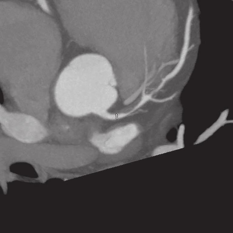 hjerte-ct kan bibringe vigtig information, f.eks. før TAVI (Transcatheter Aortic Valve Implantation) og ablation av atrieflimmer, ved mistanke om koronare anomalier mv.