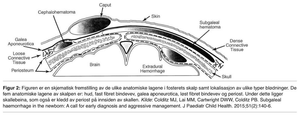 7 Ekstrakraniale hodeskader Ekstrakraniale hodeskader i hodebunnen inkluderer skalleaberasjoner og -laserasjoner, caput succedaneum, cephalhematomer og subgaleale hematomer.