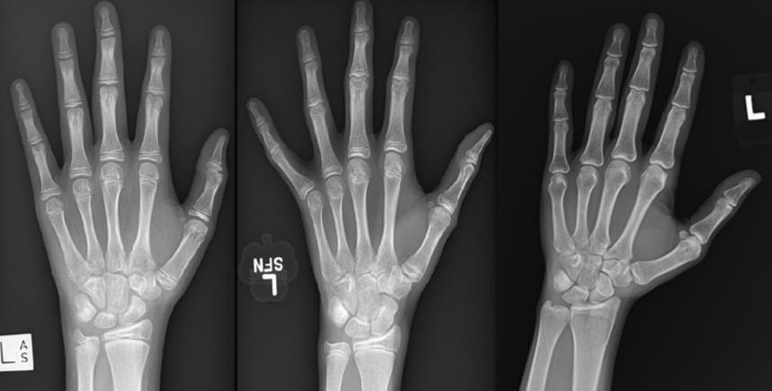 Selve metoden for vurdering av «skjelettalder» som benyttes i Norge, består i at røntgen av venstre hånd sammenlignes med bilder i GP-atlaset.