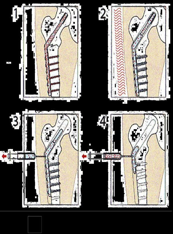 7RP R4S: FRACTFIX Main SME - Indosynt : Works generally towards the medical industry, and was established to develop and commercialise a new type of material for surgical use in traumathology.