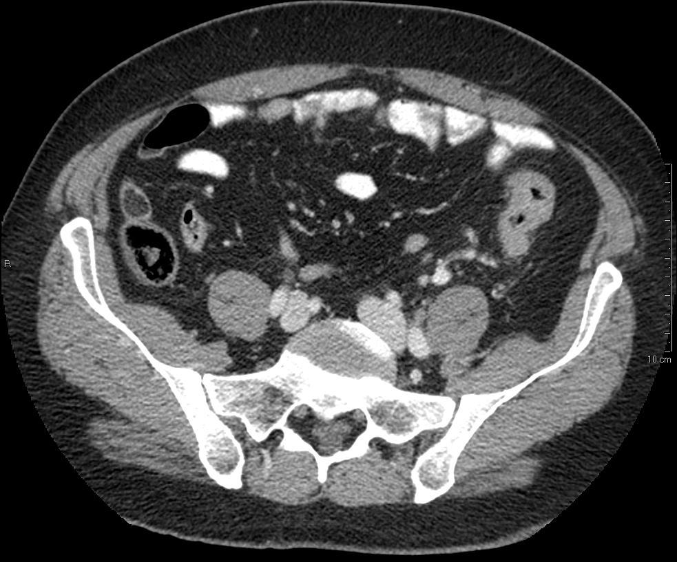 hepaticus communis middels