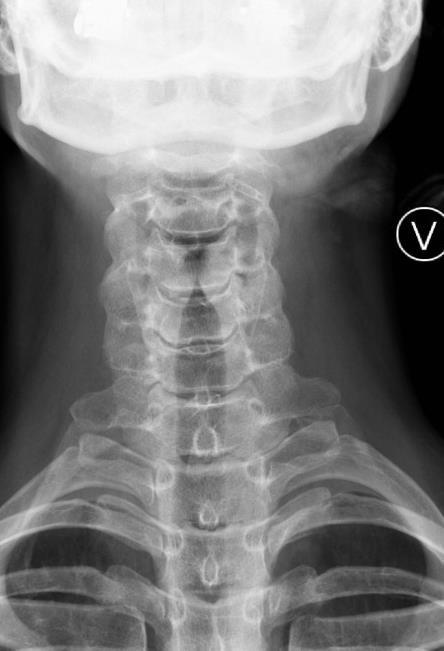 PASIENTINNSTILING til FRONT C1-C2: Evt. tannprotese tas ut.