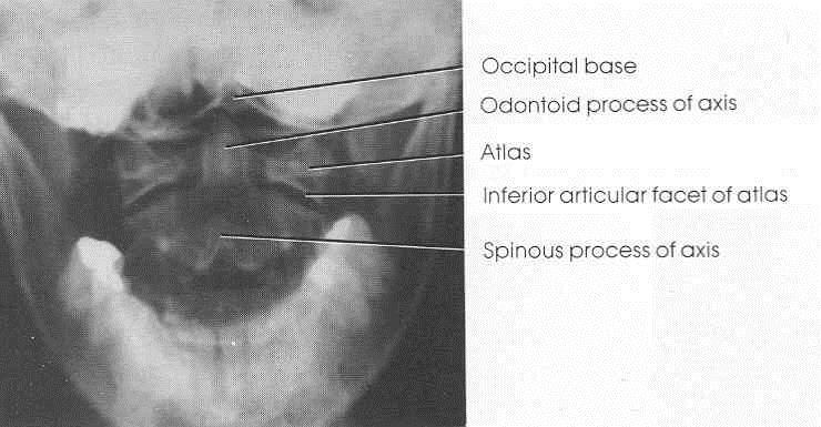 C1 og C2 projiseres fritt i den åpne munnen. PASIENTINNSTILLING til FRONT C3 - C7: Pasienten strekker nakken og tar haken litt opp. 15 gr.