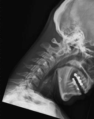 FLEKSJON: Haken trekkes godt inntil halsen samtidig som nakken bøyes fremover. Pasienten skal bøye nakken både i øvre og nedre del.