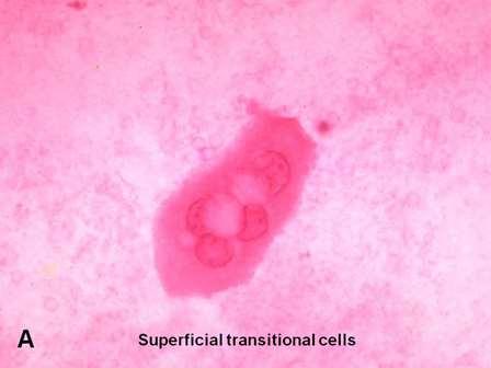 Urotel Figur 2-6. Normalt urotel, cytologi. A: superfisielle (overflate-) celler «paraplyceller». B: intermediære celler fra et dypere lag i urotelet. Kilde: American Urological Association.