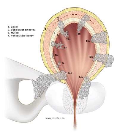 Figur 2-7. Snitt gjennom blæreveggen med stadier av blærekreft. Kilde:Tilgjenelig fra: www.oncolex.no (11). T- Komponenten Cystoskopi er ledd i utredningen av blærtumor, hvor stadiet bestemmes.