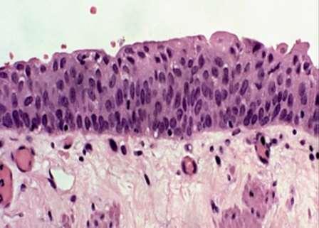 B: Økt celleprolifersjon (Hyperplasi), viser tegn på fortykket slimhinne uten atypiske forandringer.