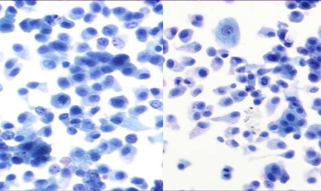 Figur 2-13. A: Uroteliale celler med lavgradig forandring. B: Uroteliale celler med reaktiv forandring. Kilde: Tilgjenegelig fra: https://www.slideshare.net/pranveerrao/urinecytology. Hentet 27.05.