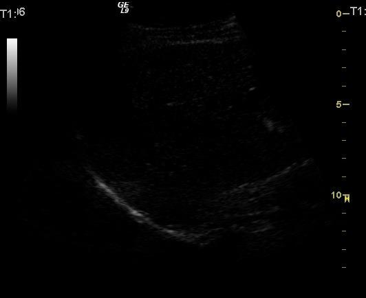 Peripheral Globular