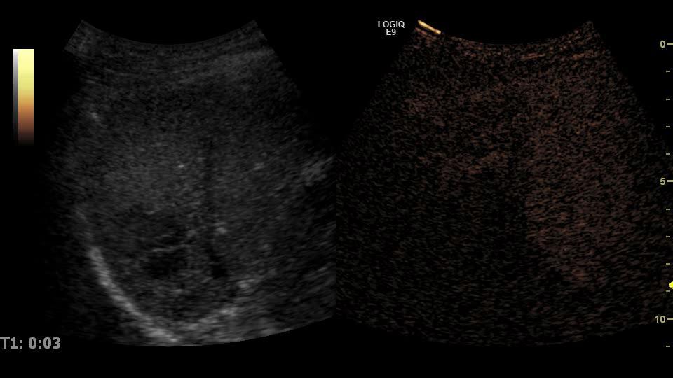 CEUS in AIH HCC?