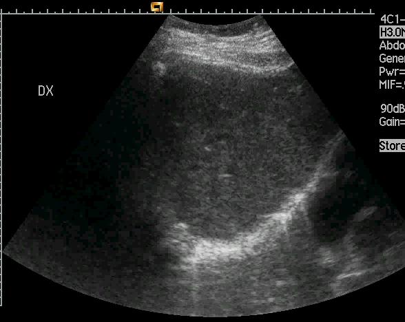 Liver Metastasis?