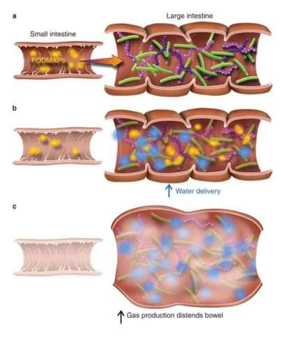 Hvordan gir FODMAP økte plager? Absorberes dårlig i tynntarmen, som passerer ufordøyd til colon. De ufordøyde karbohydratene virker osmotisk og trekker med seg væske.