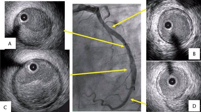 Intrakoronar ultralyd Supplement til koronar angiografi Ultralydkateter føres inn på samme måte som PCIballong 20-40