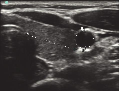 Figur 5-1 2D-bilde med én avstands- og én omkretsmåling 2D-målinger Du kan foreta en kombinasjon av målinger av avstand, område og omkrets samtidig. Totalt mulig antall avhenger av rekkefølge og type.