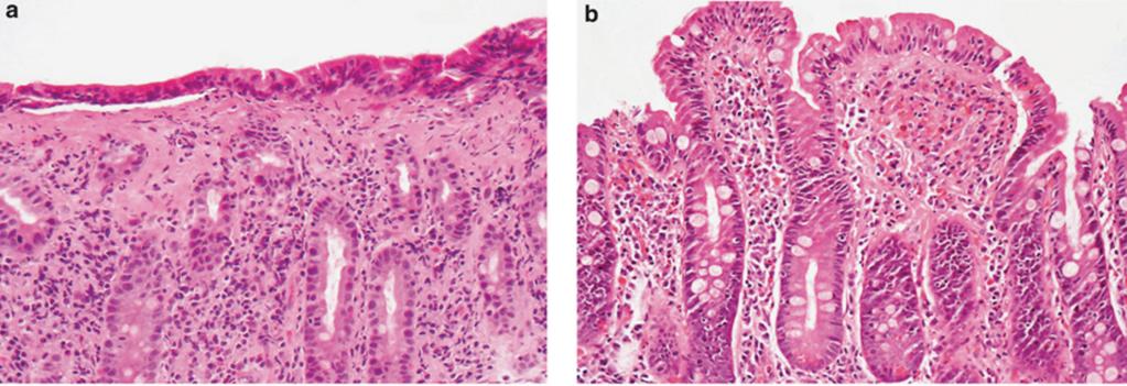 inflammasjon av tarmepitelet. Gliadin virker også direkte på epitelet ved å aktivere immunsystemet via reprogrammering av cytotoksiske T-lymfocytter til drepeceller i tarmepitelet.