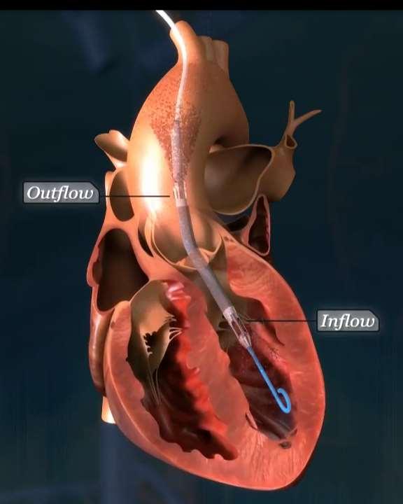 Impella