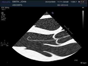 Correct Positioning of Impella Catheter (TEE) Catheter inlet area about 4 4.