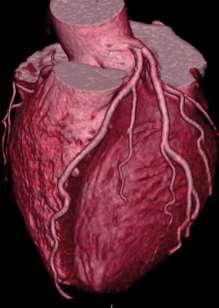 CT undersøkelse av koronararteriene er i ferd med å etablere seg som et nyttig diagnostisk verktøy i klinikken.