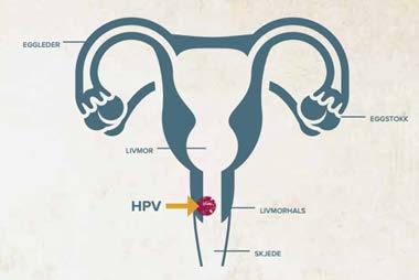 Cervarix fra høsten 2017 Cervarix inneholder antigener fra HPV 16 og 18, ikke 6 og 11 HPV 16 og 18 er ansvarlig for 70% av all livmorhalskreft Studier viser at Cervarix beskytter mot over 90%